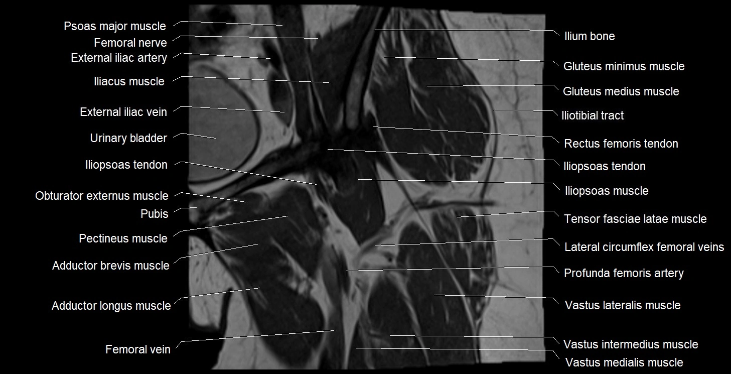 MRI Hip 3T coronal cross sectional anatomy image 19.webp